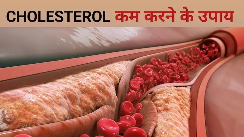 High cholesterol kaise kam karen LDL cholesterol