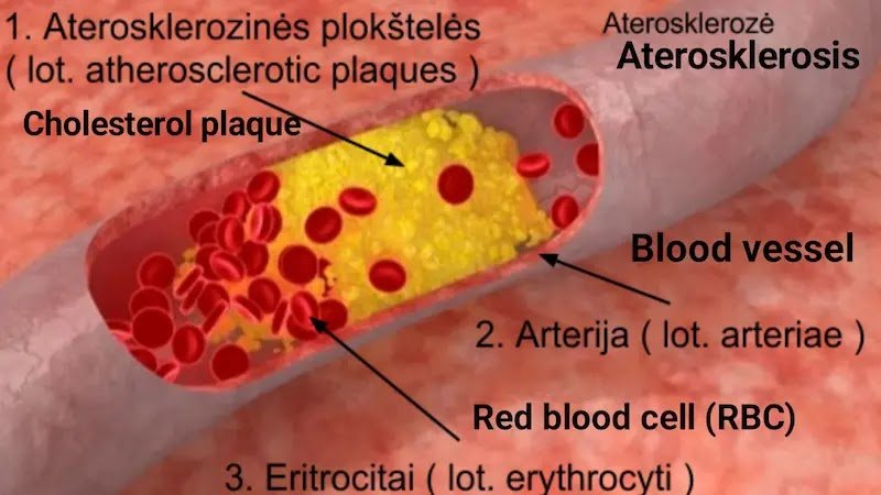High cholesterol