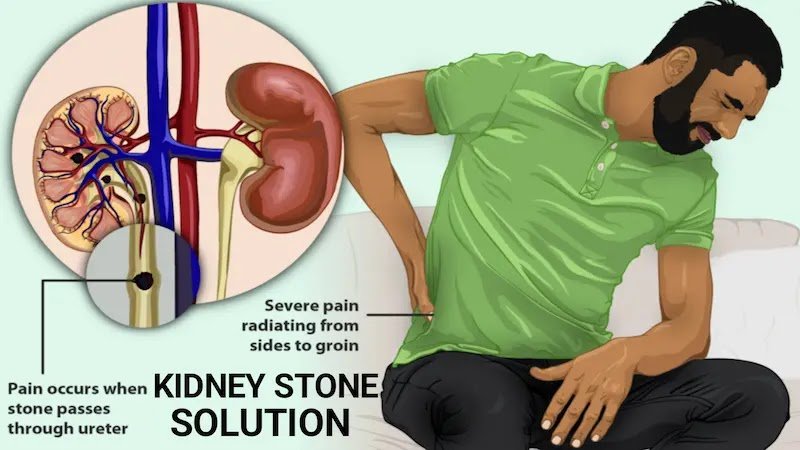 Kidney stone treatment home remedies
