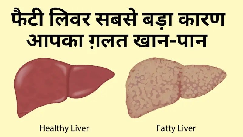 Fatty liver home remedies, fatty liver diet