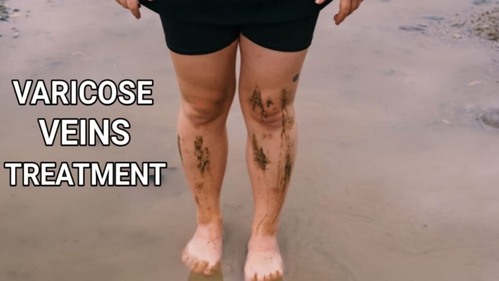 Varicose veins treatment