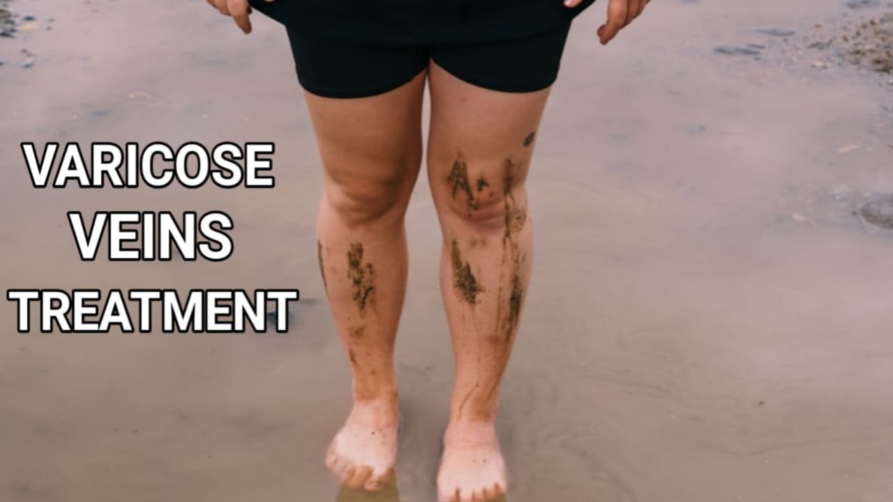 Varicose veins treatment